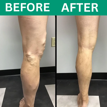 Oakwell™ 3-in-1 Leg Massager For Varicose Veins Hypersku