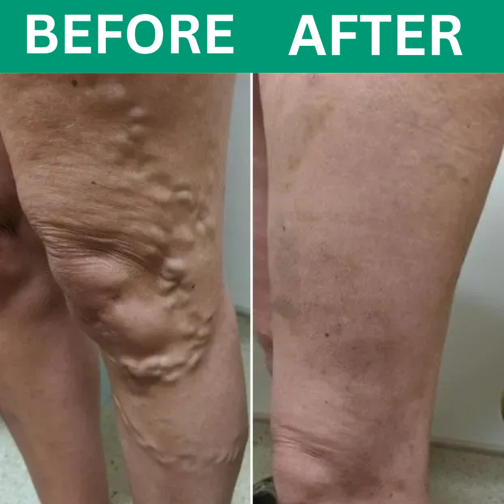 Oakwell™ 3-in-1 Leg Massager For Varicose Veins Hypersku
