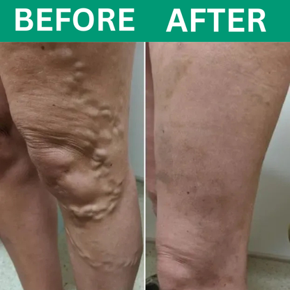 Oakwell™ 3-in-1 Leg Massager For Varicose Veins Hypersku