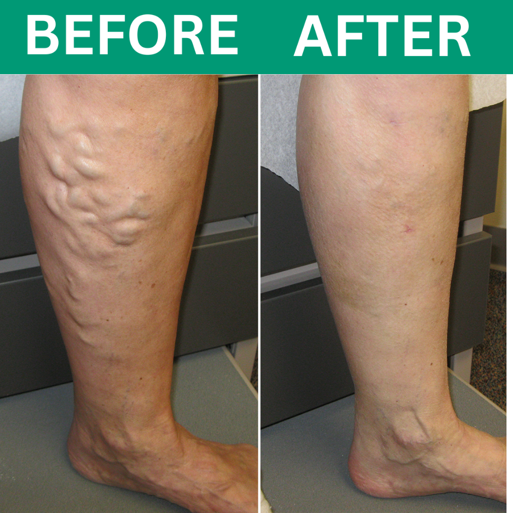 Oakwell™ 3-in-1 Leg Massager For Varicose Veins Hypersku