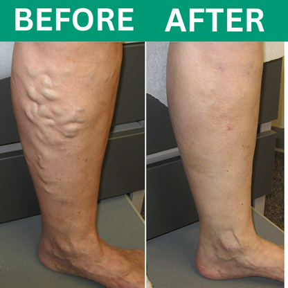 Oakwell™ 3-in-1 Leg Massager For Varicose Veins Hypersku